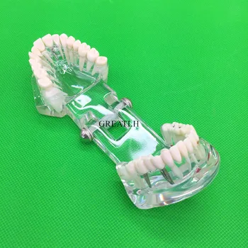 Dinții Model de Implant Dentar Boli de Dinți Model Cu Restaurarea Podului Dinte la Dentist Pentru predare