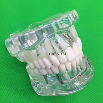 Dinții Model de Implant Dentar Boli de Dinți Model Cu Restaurarea Podului Dinte la Dentist Pentru predare